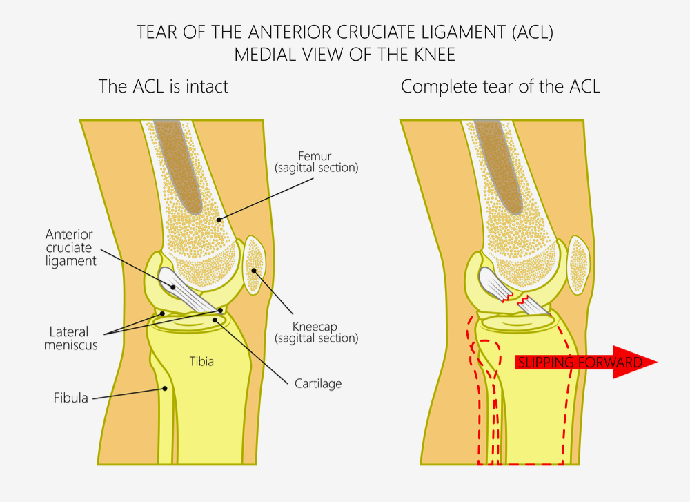 Common Causes of Anterior Cruciate Ligament (ACL) Injuries
