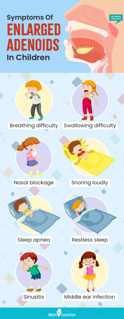 Common Symptoms of Adenoiditis Common Symptoms of Adenoiditis