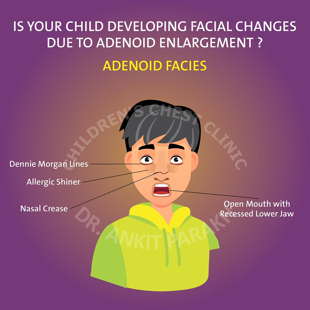 Common Symptoms of Adenoiditis Common Symptoms of Adenoiditis