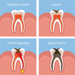 Common Symptoms of Dental Abscesses Common Symptoms of Dental Abscesses