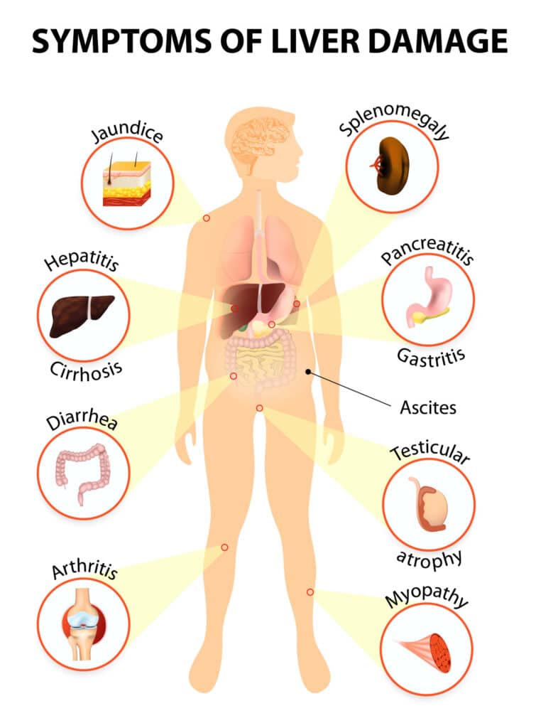 Common Symptoms of Liver Disease Common Symptoms of Liver Disease
