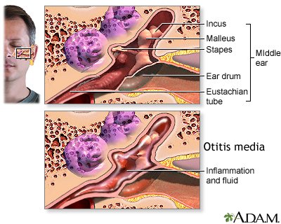 Complications of Ear Infections