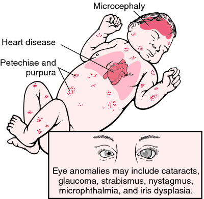 Congenital Rubella And Its Implications - Ask The Nurse Expert