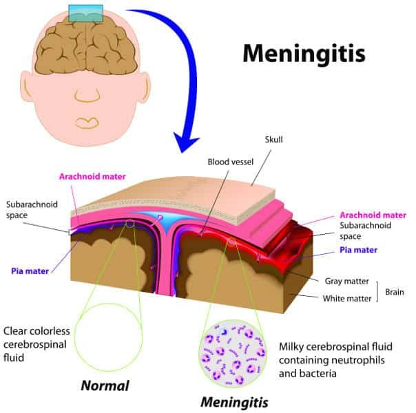 Coping with Meningitis: Support and Recovery Strategies