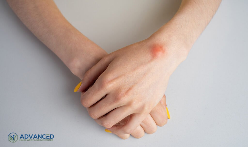 Debunking Ganglion Cyst Myths: Facts and Fiction Revealed