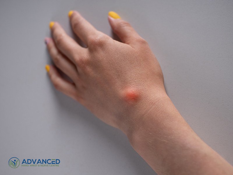 Debunking Ganglion Cyst Myths: Facts and Fiction Revealed