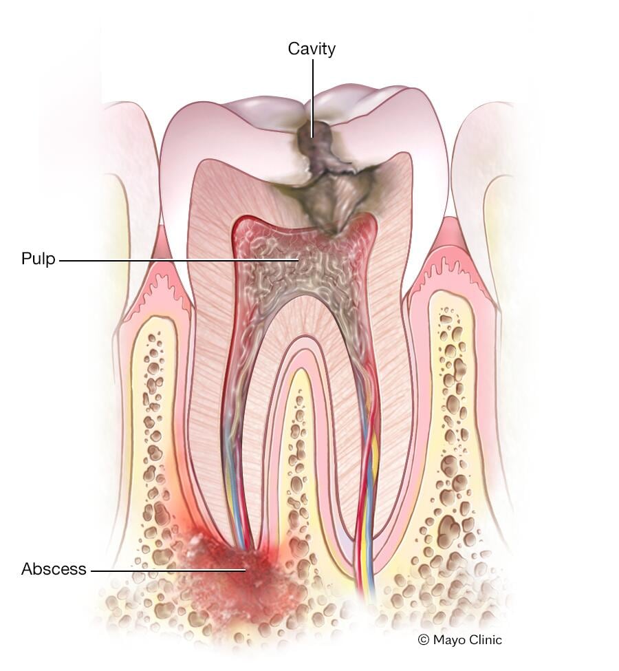 Dental Abscess Complications Dental Abscess Complications