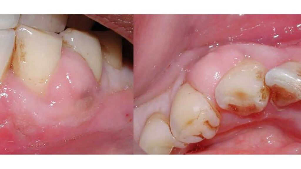 Dental Abscess Complications Dental Abscess Complications