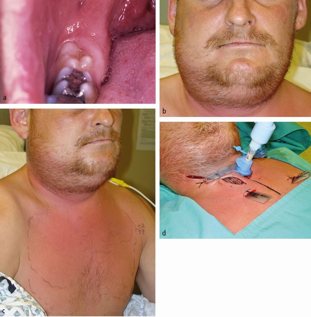 Dental Abscess Complications Dental Abscess Complications