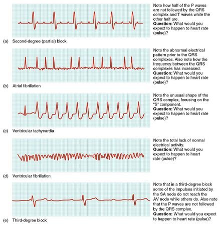 Detecting Arrhythmia: Symptoms and Diagnostic Tests