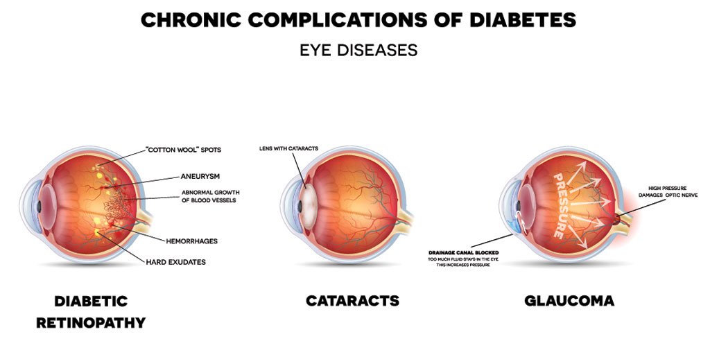 Diabetes Mellitus and Eye Health