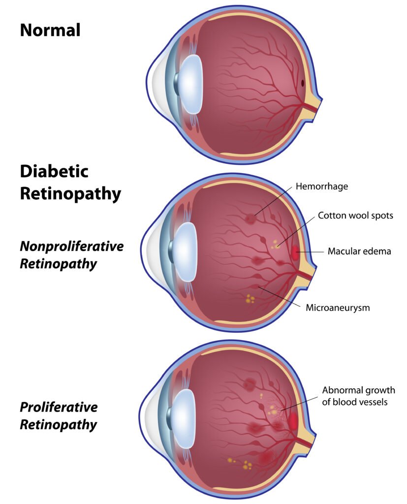 Diabetes Mellitus and Eye Health