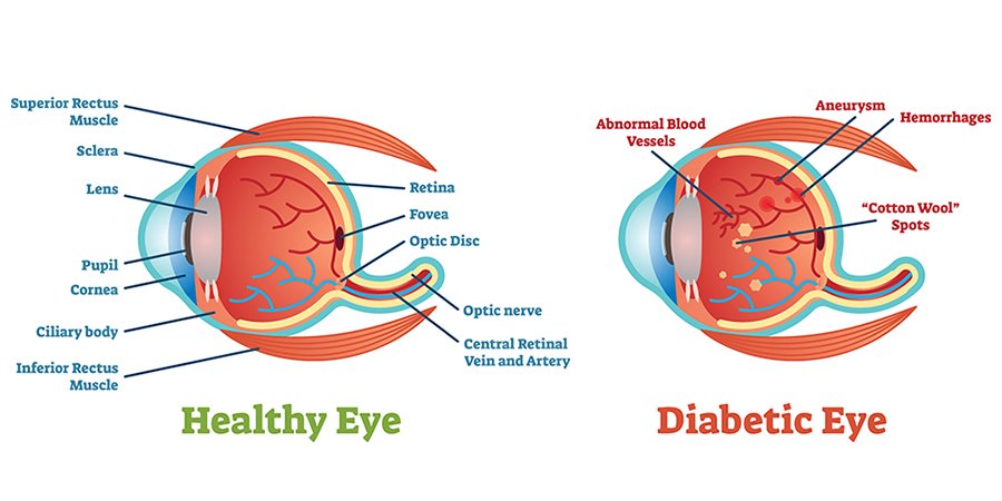 Diabetes Mellitus and Eye Health