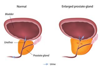 Diagnosing an Enlarged Prostate
