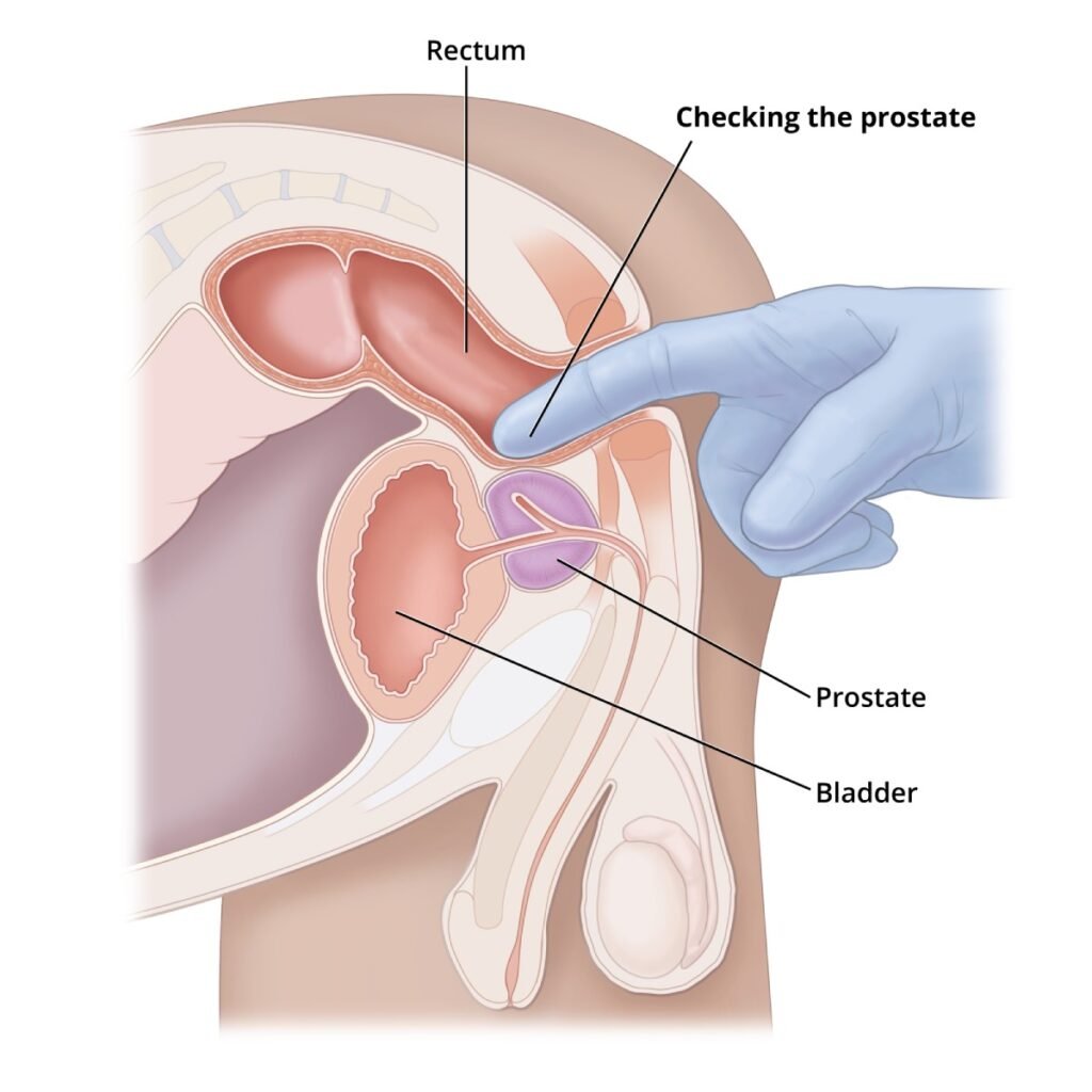 Diagnosing an Enlarged Prostate