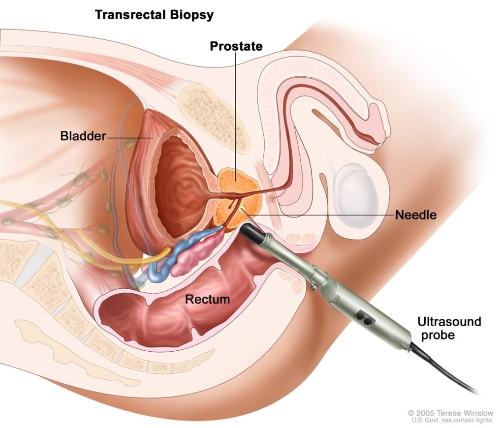 Diagnosing an Enlarged Prostate