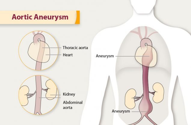 Diagnosing and Treating Abdominal Aortic Aneurysms