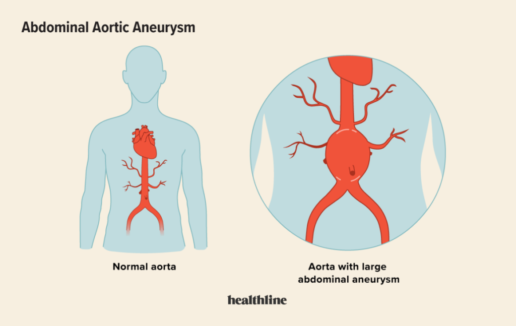 Diagnosing and Treating Abdominal Aortic Aneurysms