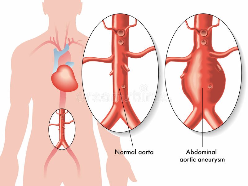 Diagnosing and Treating Abdominal Aortic Aneurysms