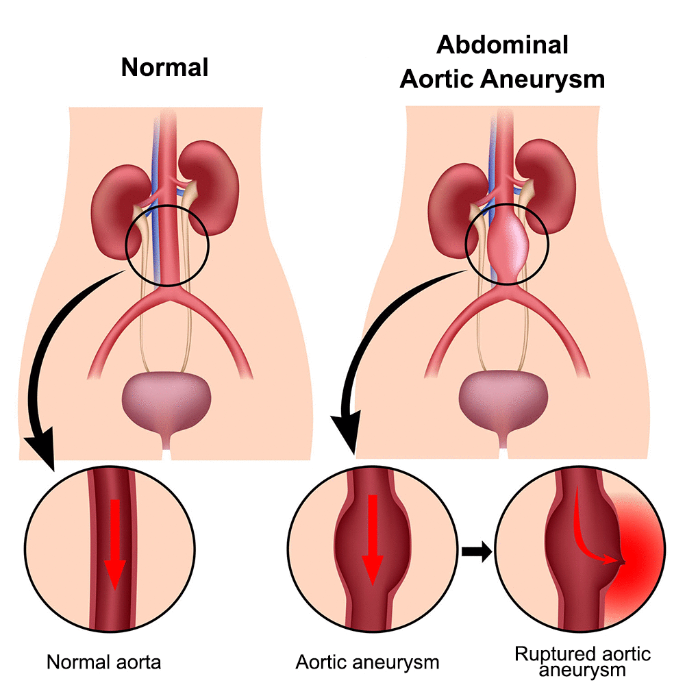 Diagnosing and Treating Abdominal Aortic Aneurysms