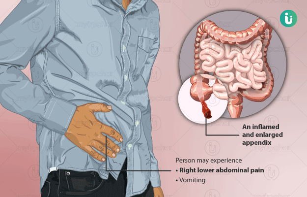 Diagnosing Appendicitis: Key Signs and Indicators