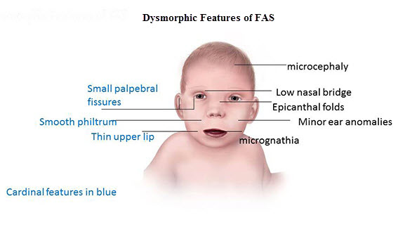 Diagnosing Fetal Alcohol Syndrome Diagnosing Fetal Alcohol Syndrome