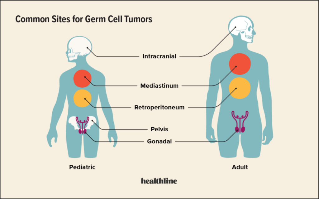 Diagnosis and Treatment of Germ Cell Tumors