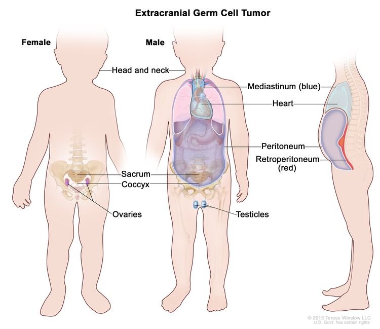 Diagnosis and Treatment of Germ Cell Tumors