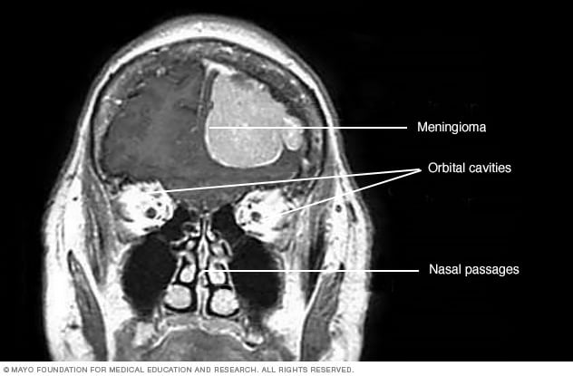 Diagnosis and Treatment of Meningioma
