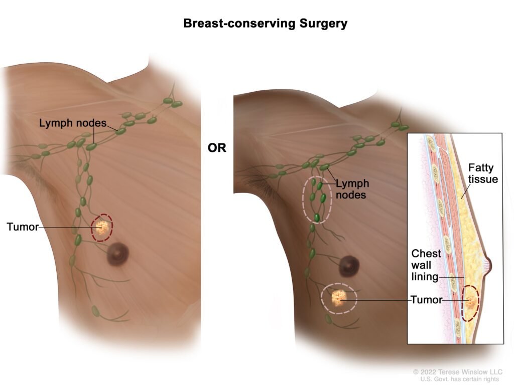 Diagnosis and Treatment Options for Male Breast Cancer