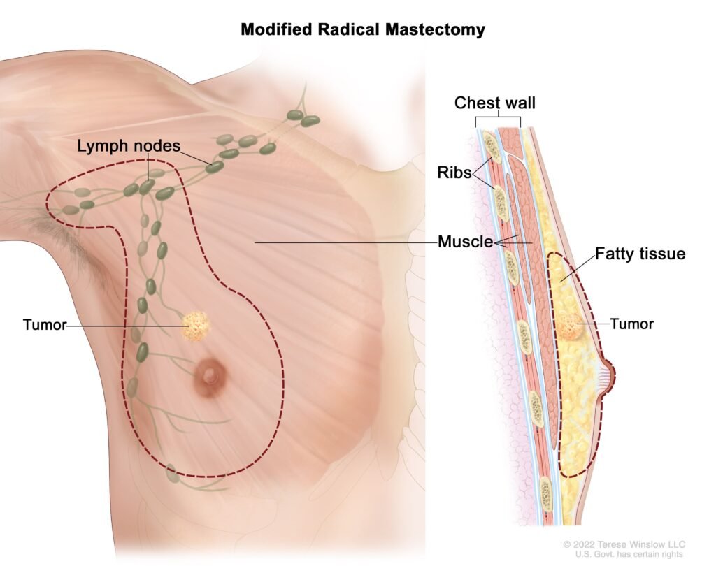 Diagnosis and Treatment Options for Male Breast Cancer