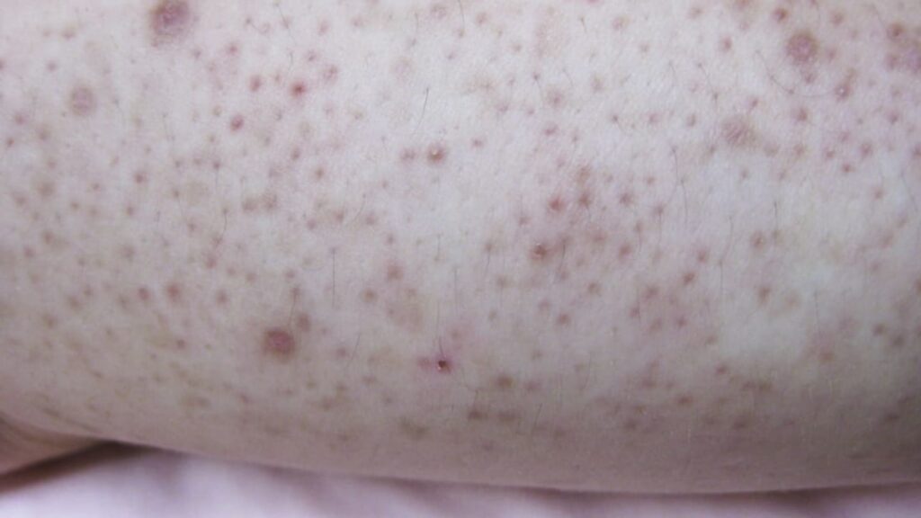 Discovering the Truth About Keratosis Pilaris: Myths vs Facts