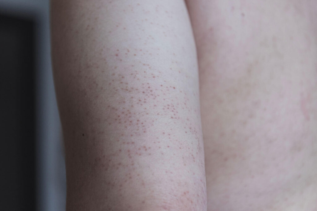 Discovering the Truth About Keratosis Pilaris: Myths vs Facts