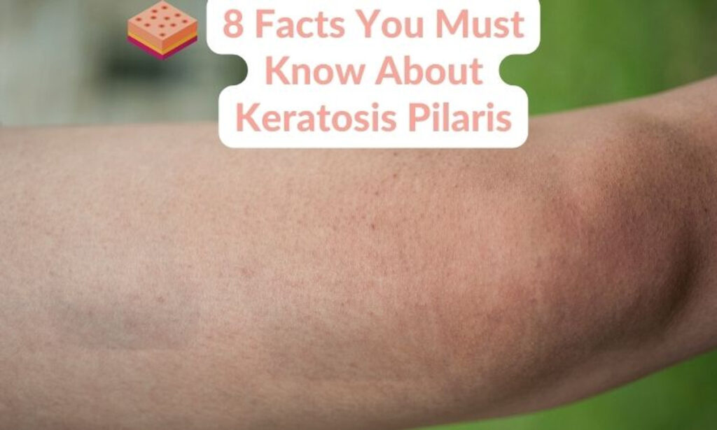 Discovering the Truth About Keratosis Pilaris: Myths vs Facts