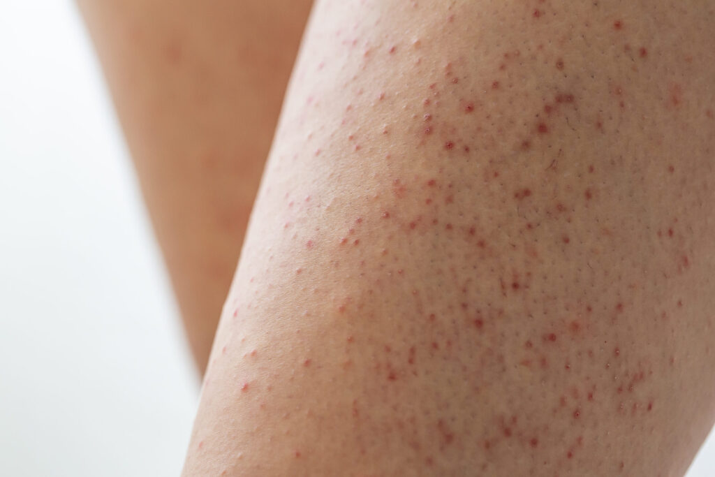 Discovering the Truth About Keratosis Pilaris: Myths vs Facts