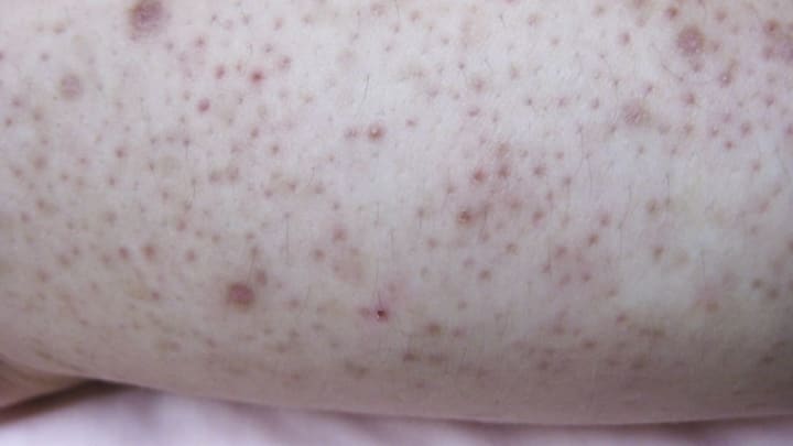 Discovering the Truth About Keratosis Pilaris: Myths vs Facts