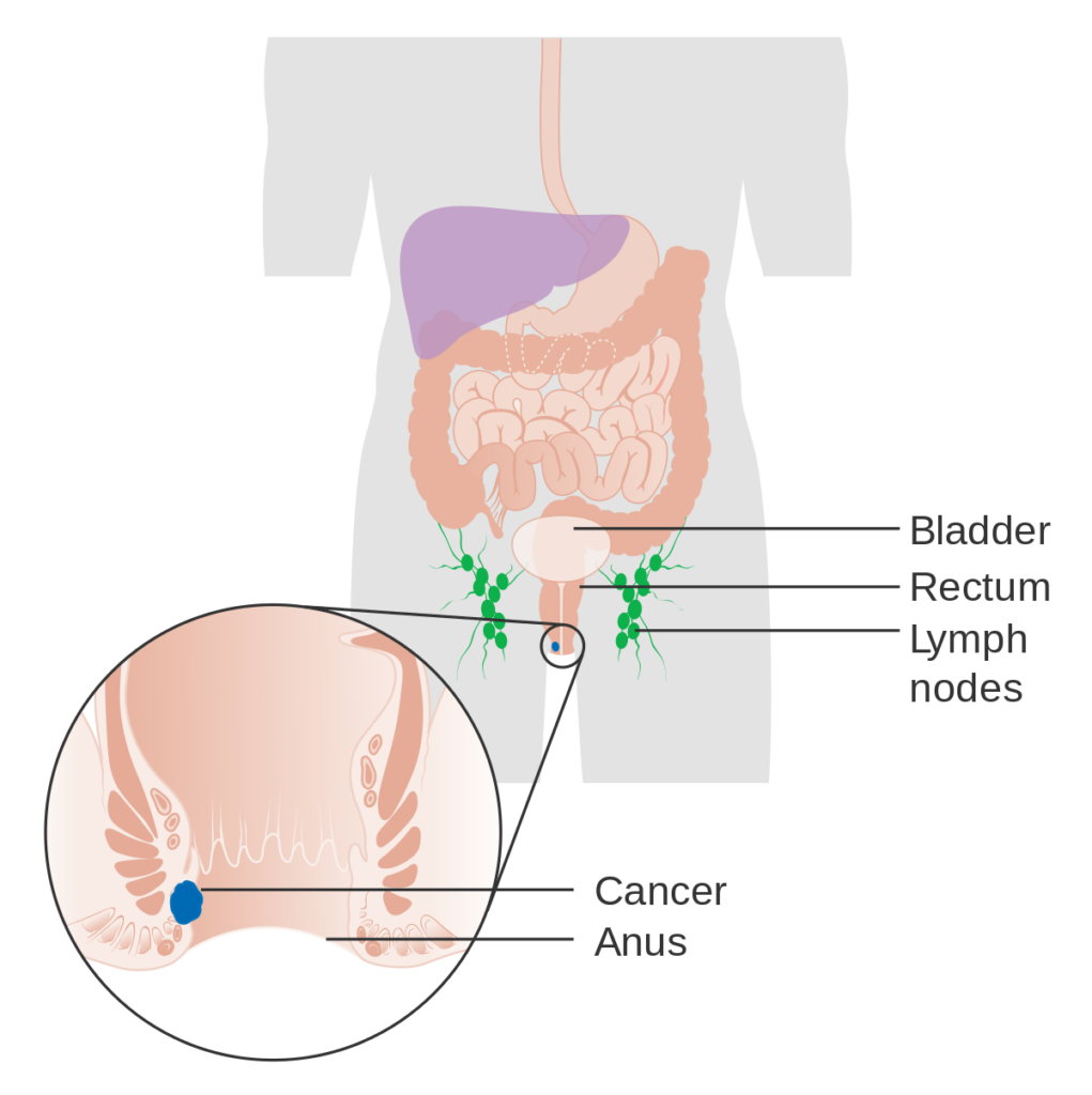 Early Detection of Anal Cancer: Key Signs to Watch For