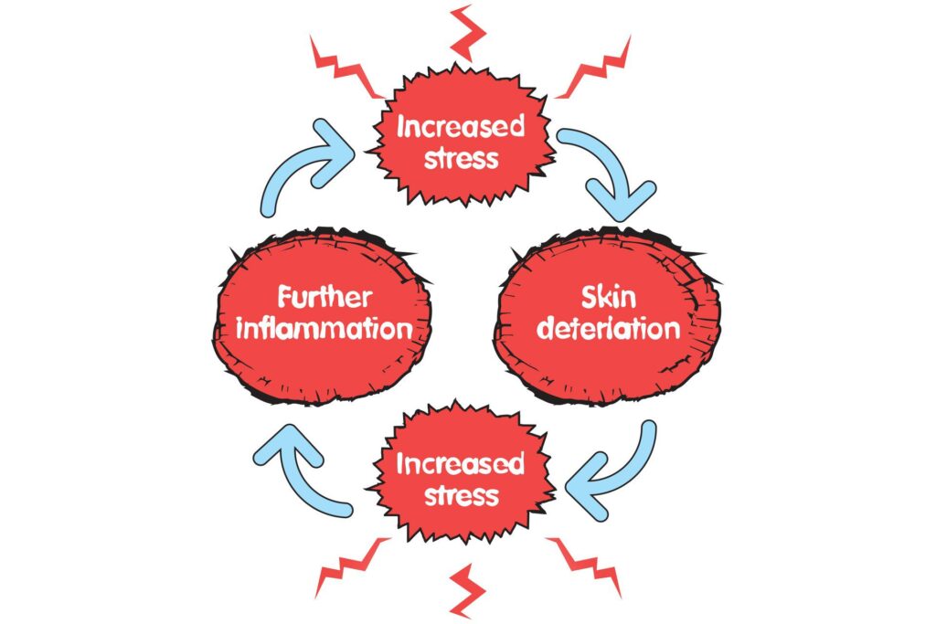 Eczema and Stress: Breaking the Cycle Eczema and Stress: Breaking the Cycle