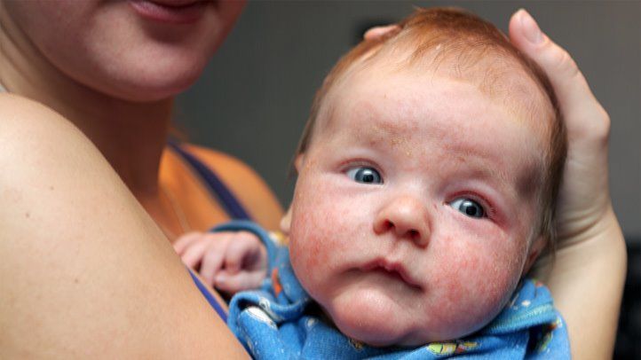 Eczema in Babies: How to Handle and Treat It Eczema in Babies: How to Handle and Treat It