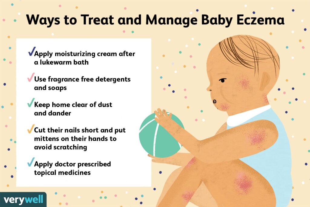Eczema in Babies: How to Handle and Treat It Eczema in Babies: How to Handle and Treat It