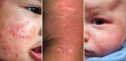 Eczema in Babies: How to Handle and Treat It Eczema in Babies: How to Handle and Treat It