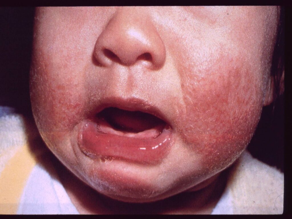 Eczema in Babies: How to Handle and Treat It Eczema in Babies: How to Handle and Treat It