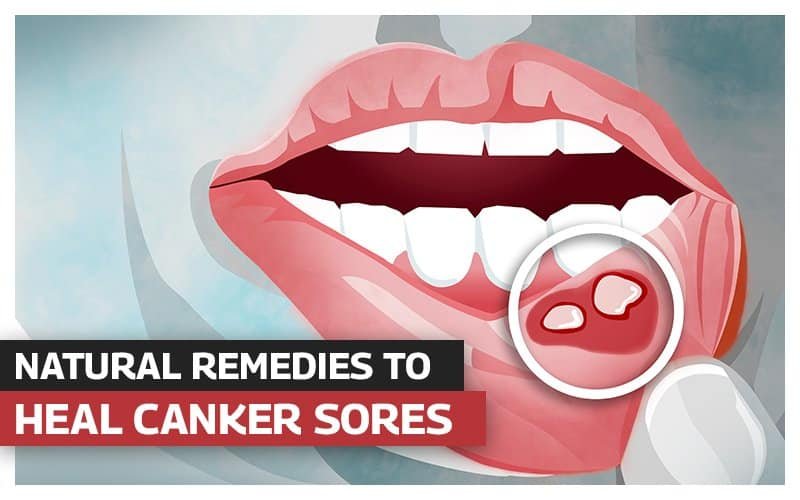 Effective Home Remedies for Mouth Ulcers