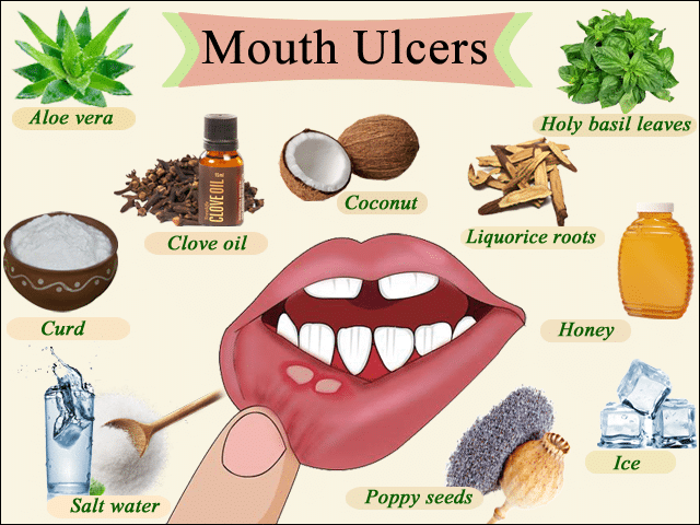 Effective Home Remedies for Mouth Ulcers