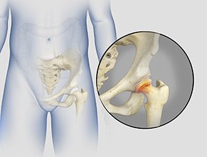 Effective Treatment for Irritable Hip