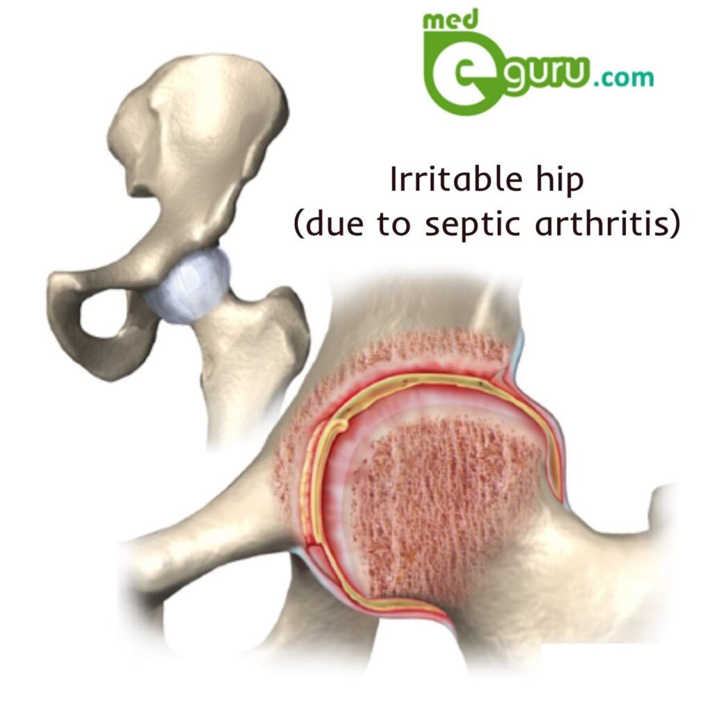 Effective Treatment for Irritable Hip