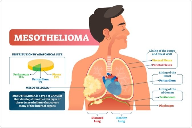 Effective Treatment Options for Asbestos Cancer