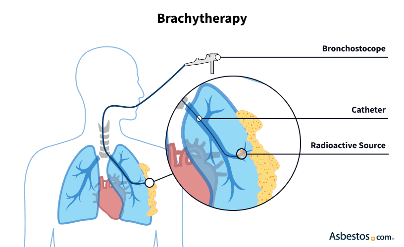 Effective Treatment Options for Asbestos Cancer