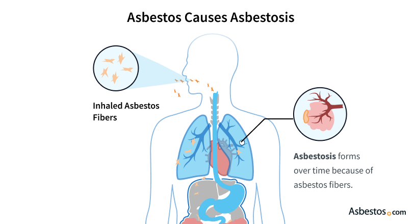 Effective Treatment Options for Asbestos Cancer