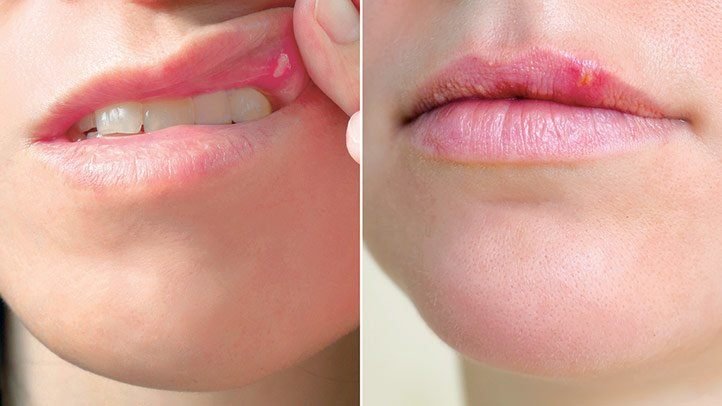 Effective Treatment Options for Cold Sores